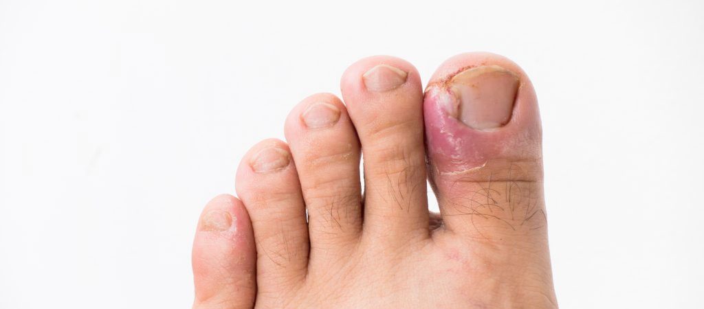 How to Ease the Pain of Ingrown Toenails, Pt. 2 - Palmetto State Podiatry