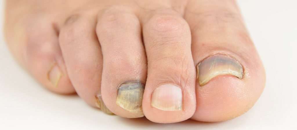 Treating and Preventing Ingrown Toenails