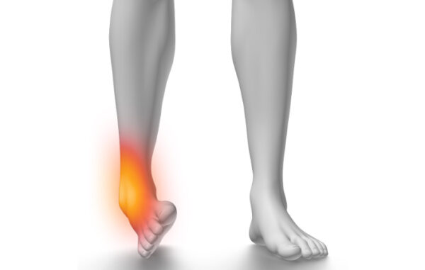 I've Sprained My Ankle - What Should I do? - Podiatry Clinic Edgware