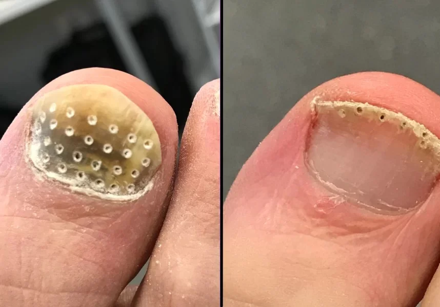 Clearanail Fungal Nail Treatment - Podiatry Station