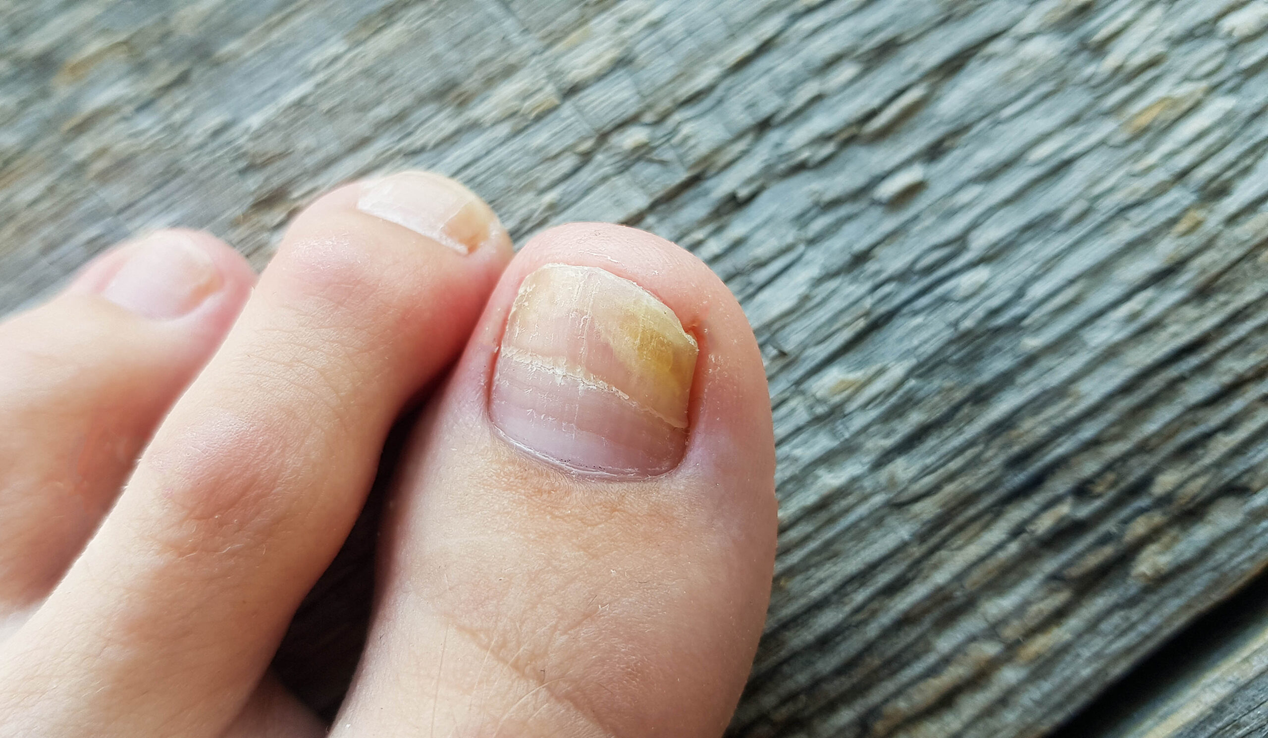 Fungus on nails