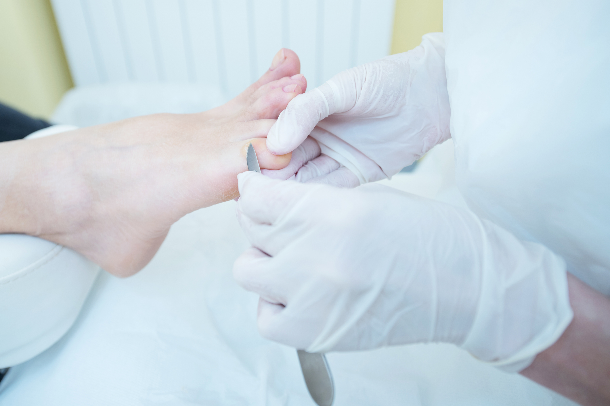 Corns & Calluses