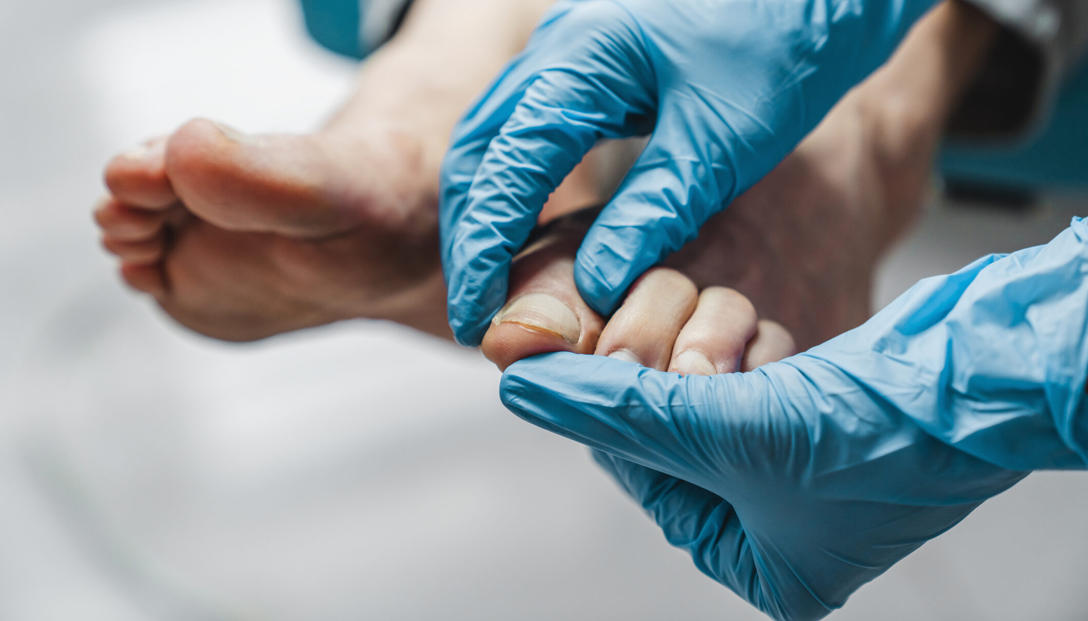 Clearanail Fungal Nail Treatment