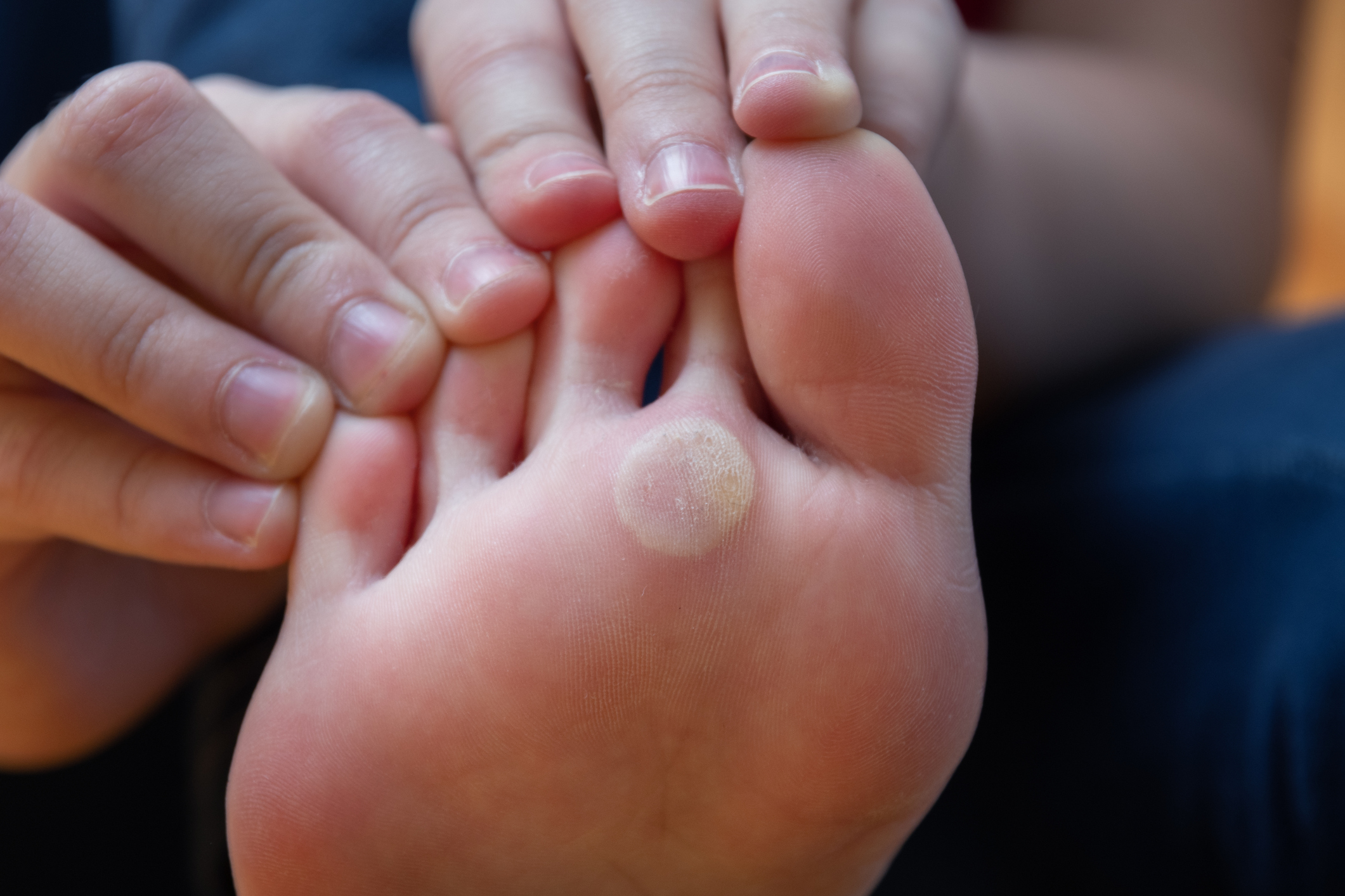 Corns & Calluses