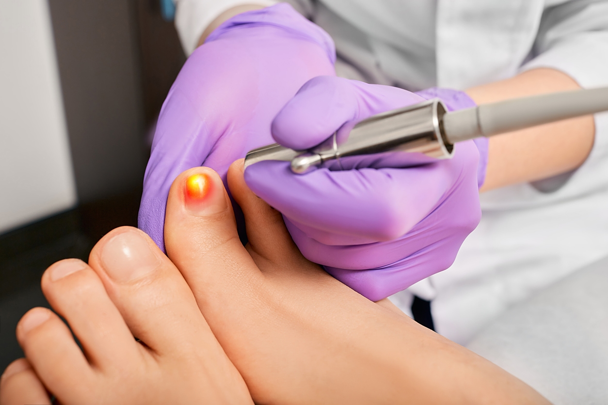 Toenail Fungus Treatment