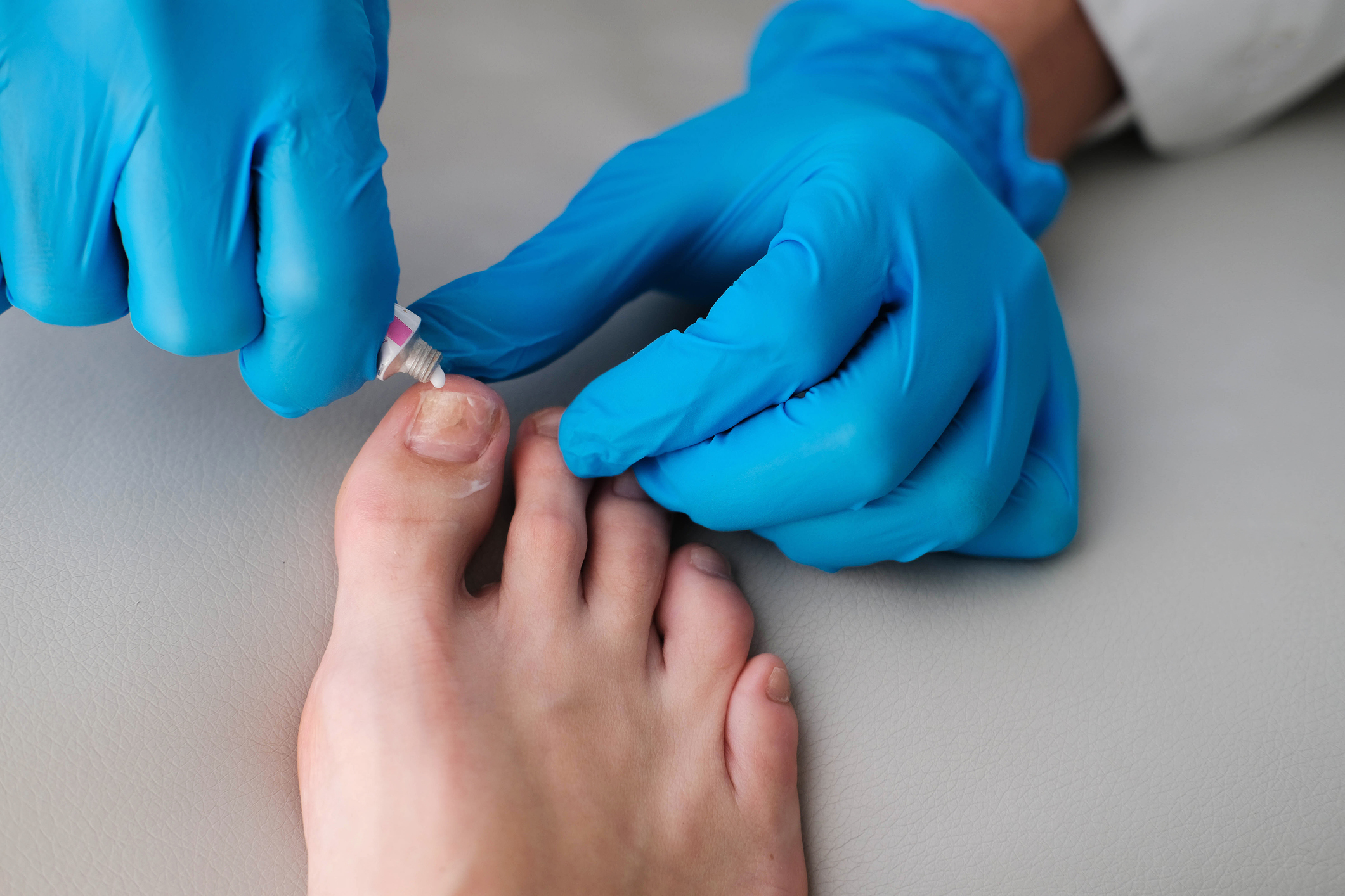 Toenail Fungus Treatment