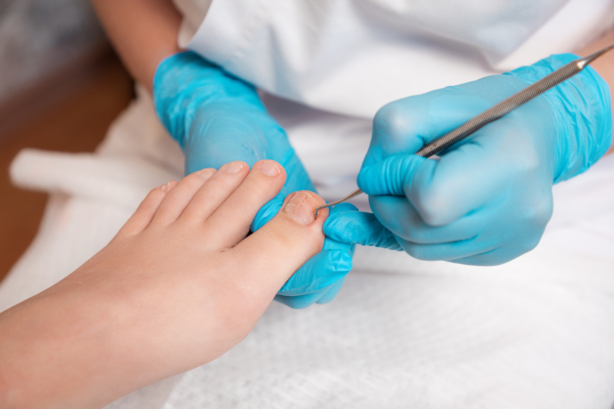 Ingrown Toenails