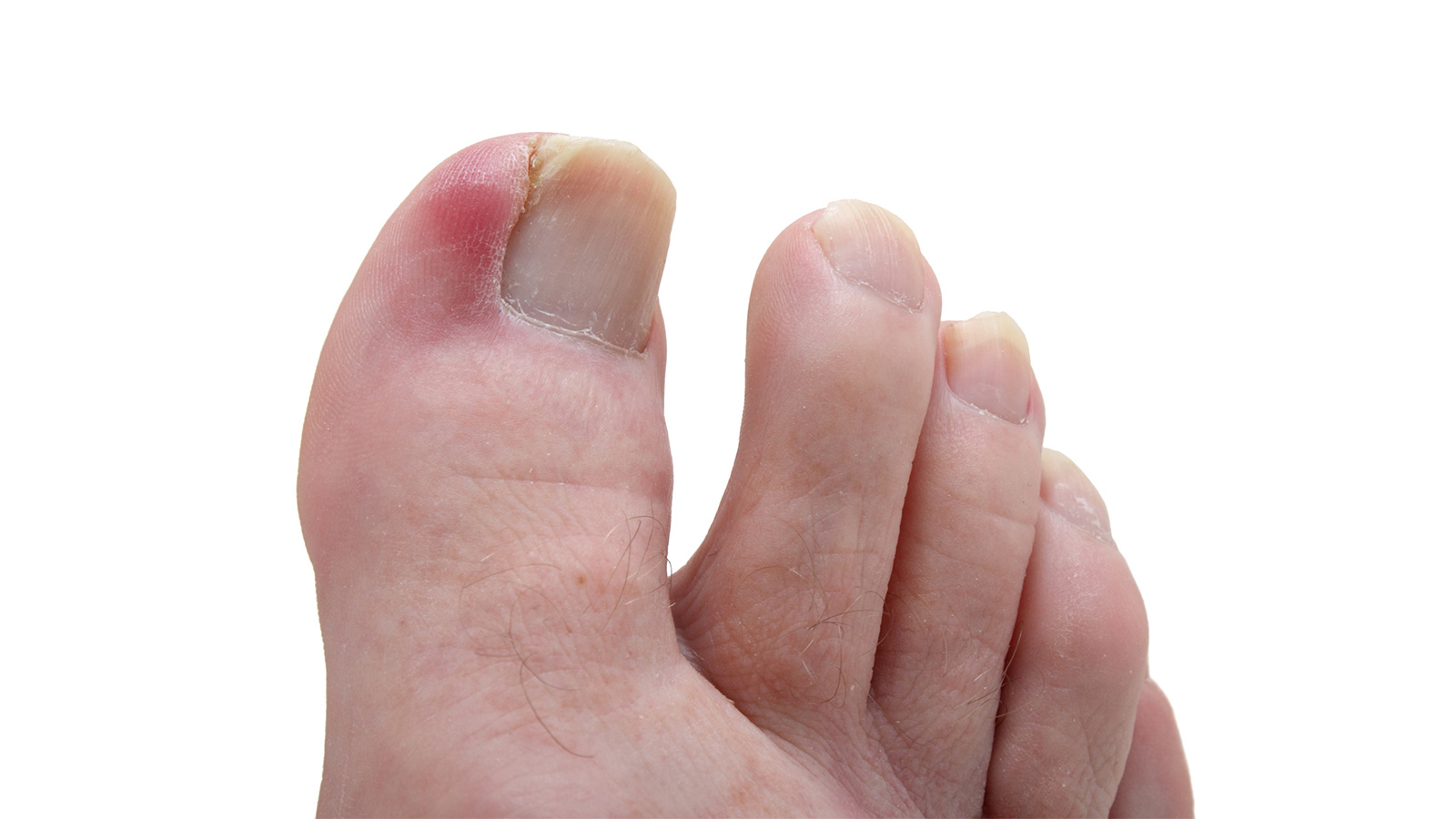 Nail Surgery