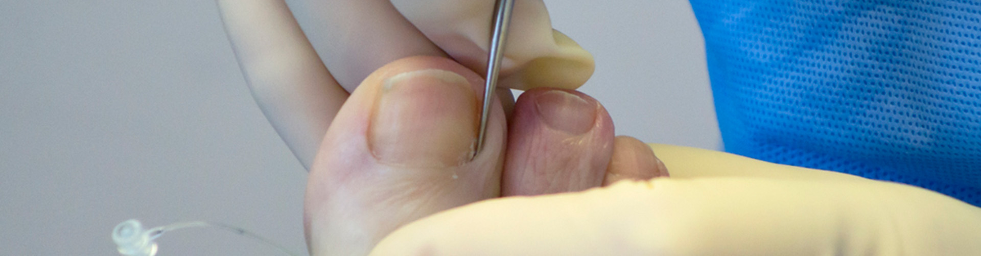 Toenail surgery