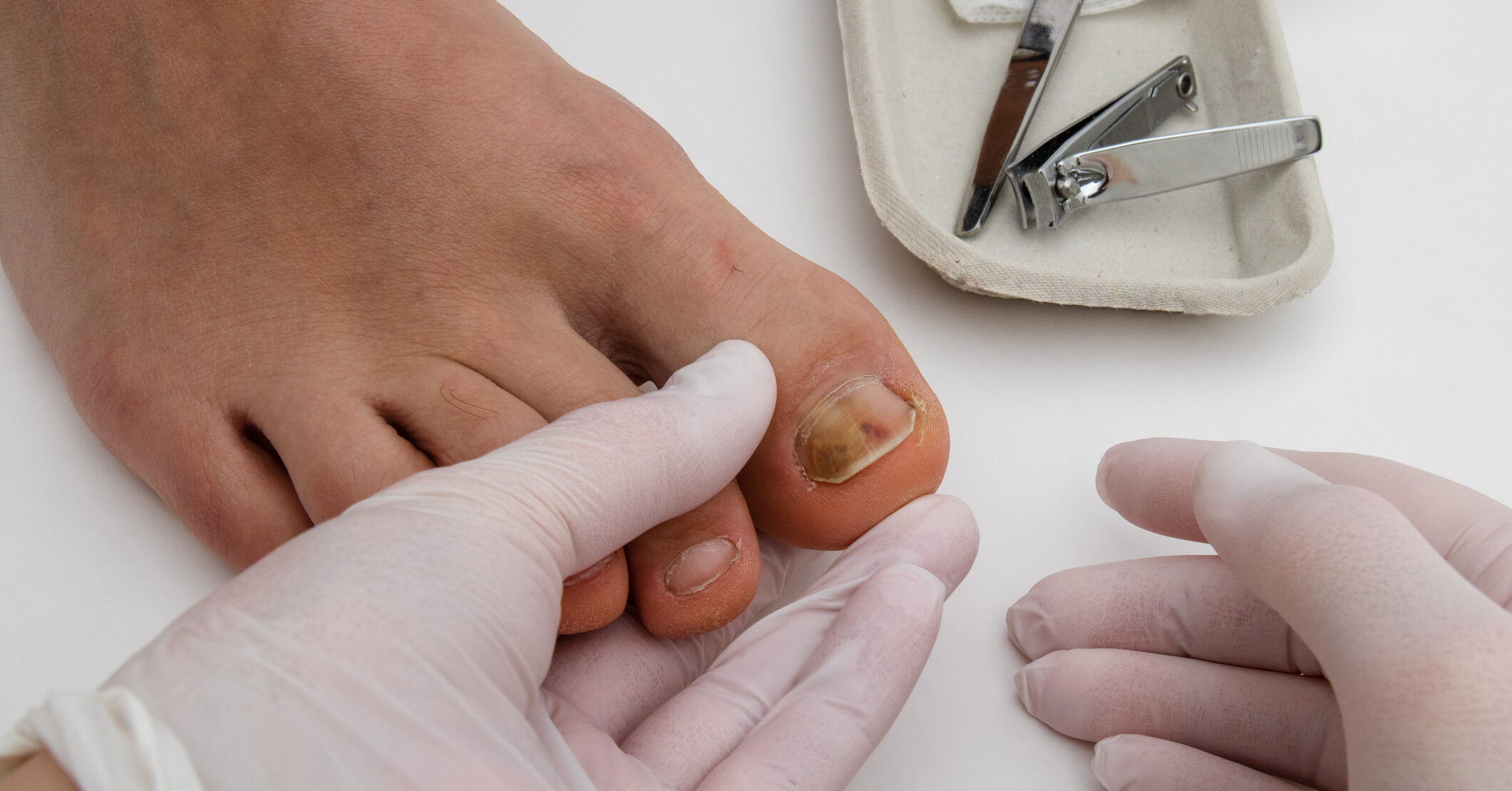 Clearanail Fungal Nail Treatment