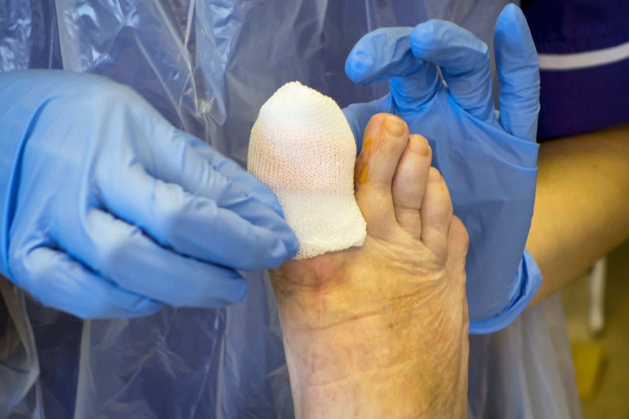 Dressing a toe after toenail surgery