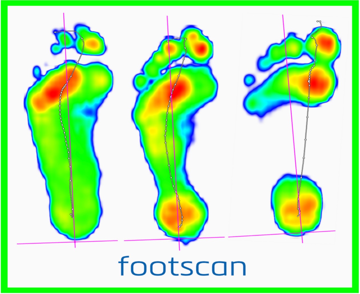 sprained and bruised ankle