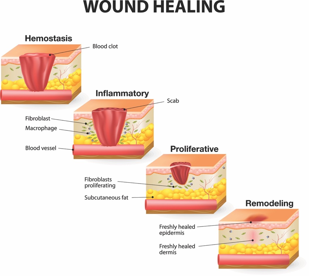 A Patients Guide to Laser For Wound Healing
