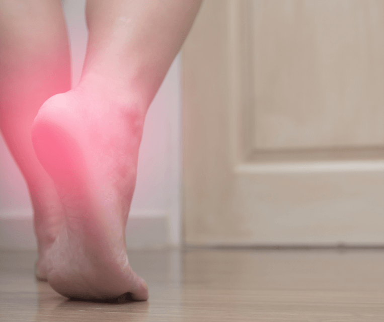 Plantar Fasciitis