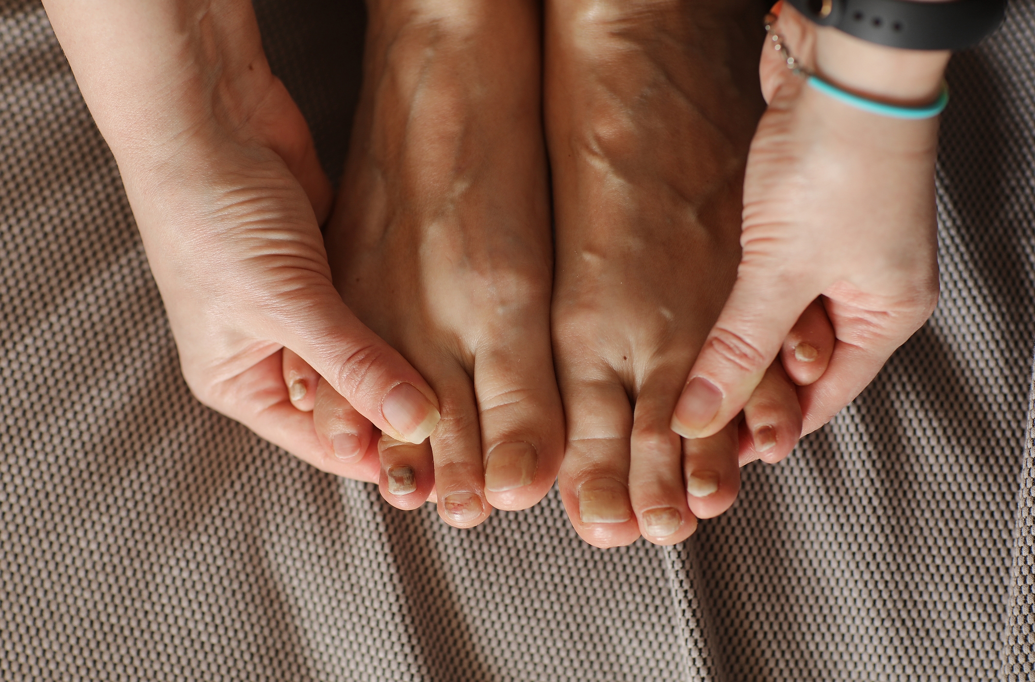 Swift Fungal Nail Treatment