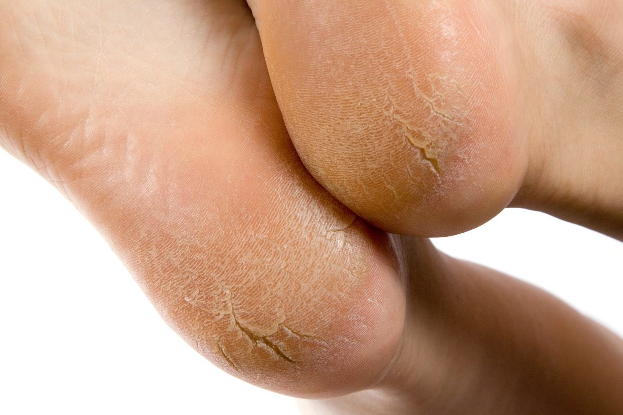 Dealing with Corns, Calluses and Cracked Heels: Causes and Care Tips