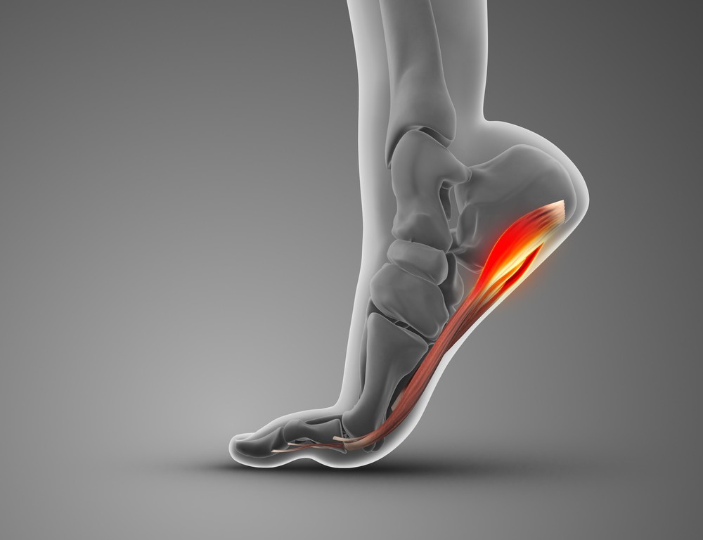 Stop the Stab: Effective Plantar Fasciitis Treatment for Edgware Residents