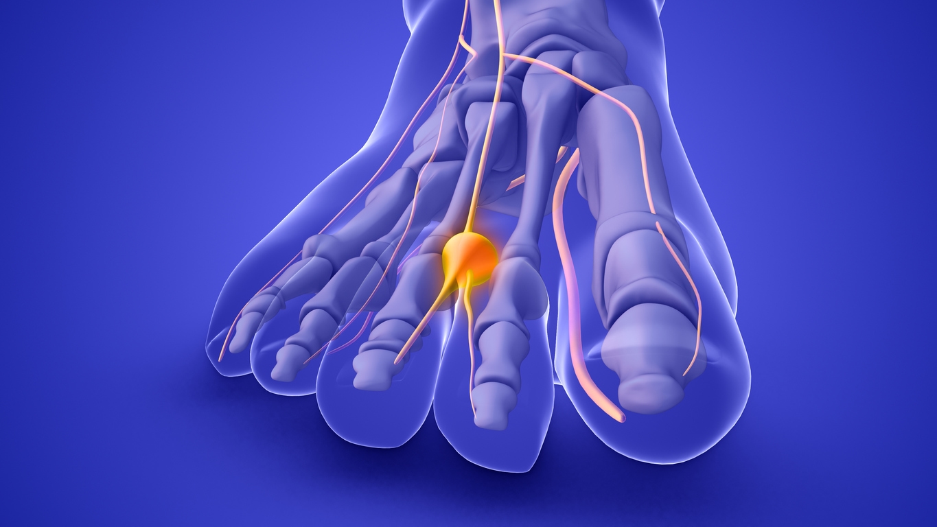Morton’s Neuroma and Ball of Foot Pain: Diagnosis and Relief in Edgware