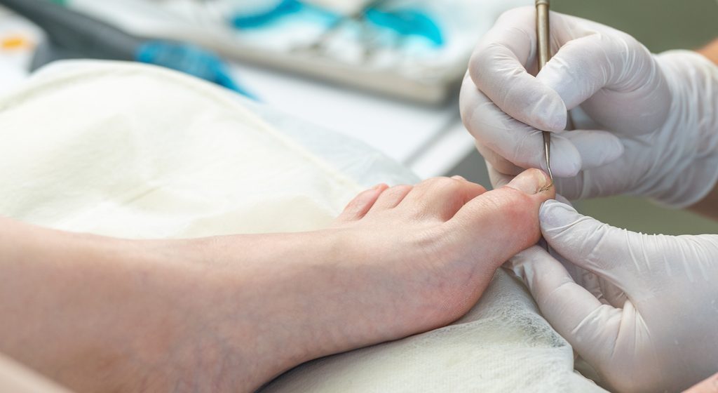 Ingrown Toenail Emergency in Edgware