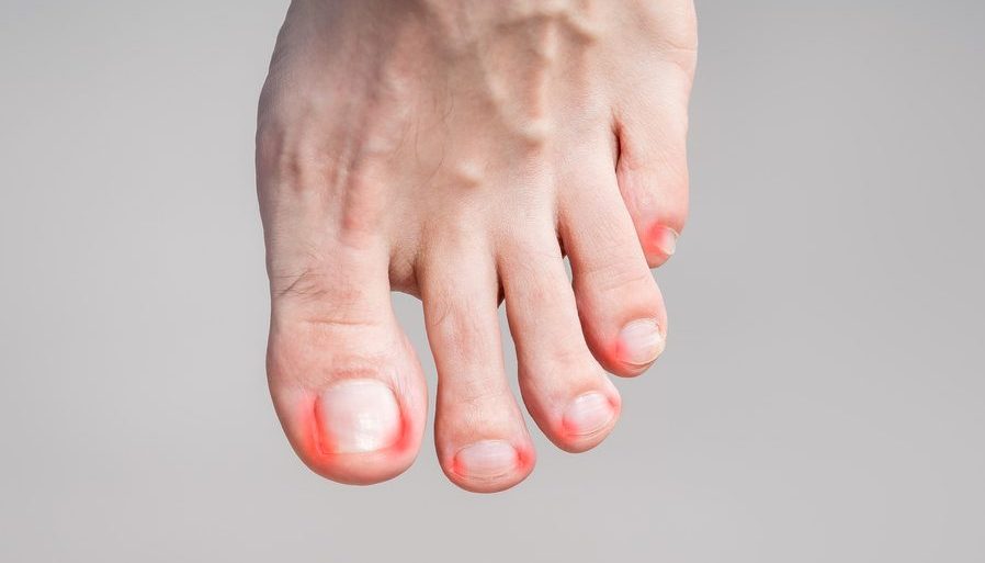 Ingrown Toenail Emergency in Edgware